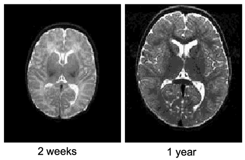 Example of neuroimaging